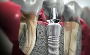 implant dentar brasov